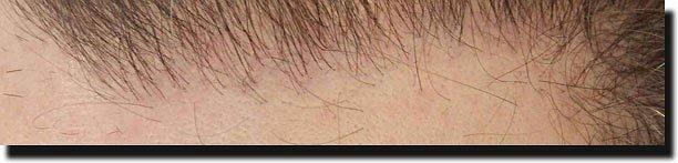 Hair restoration procedure results