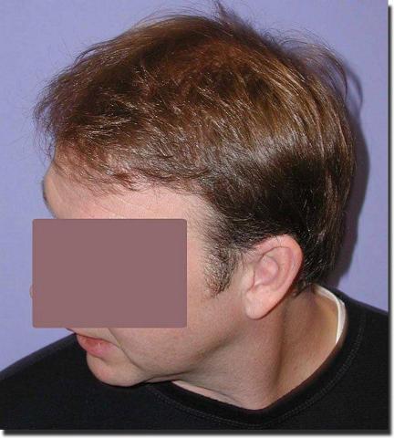 Hair restoration procedure results