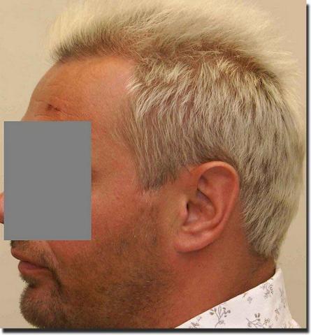 Hair restoration procedure results