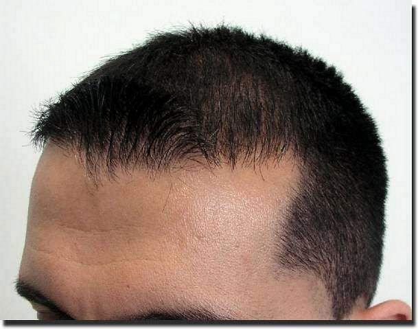 Hair restoration procedure results