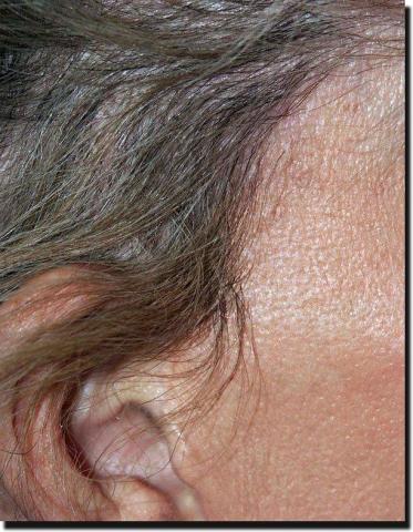 Hair restoration procedure results