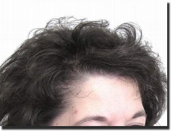 Hair restoration procedure results