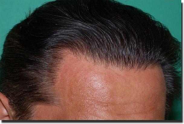 Hair restoration procedure results