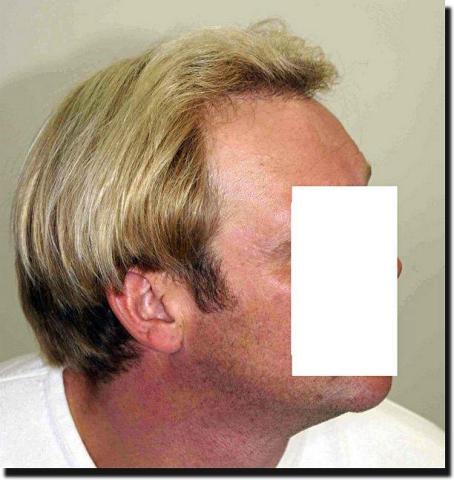 Hair restoration procedure results