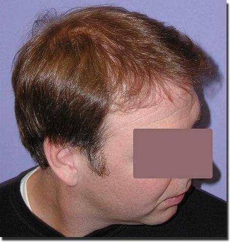 Hair restoration procedure results