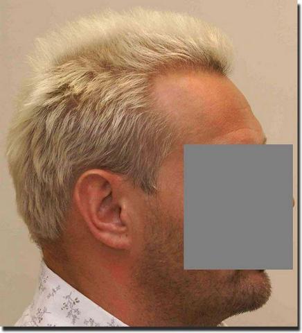 Hair restoration procedure results