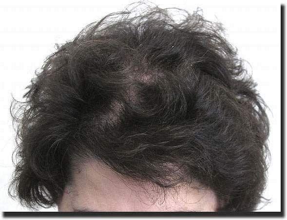 Hair restoration procedure results