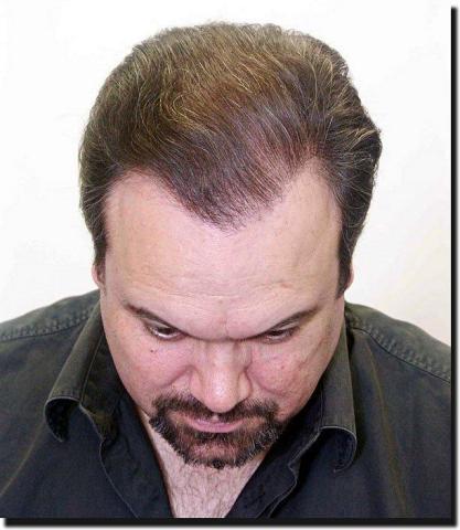 Hair restoration procedure results