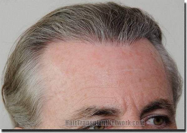 Hair restoration procedure results