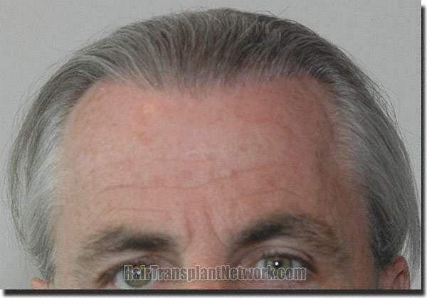 Hair restoration procedure results