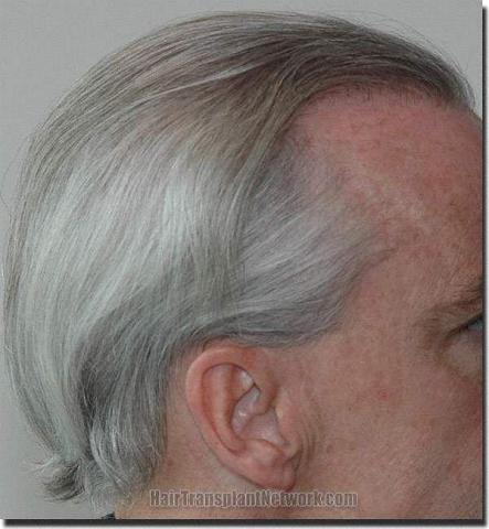 Hair restoration procedure results