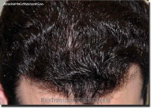 Hair restoration procedure results