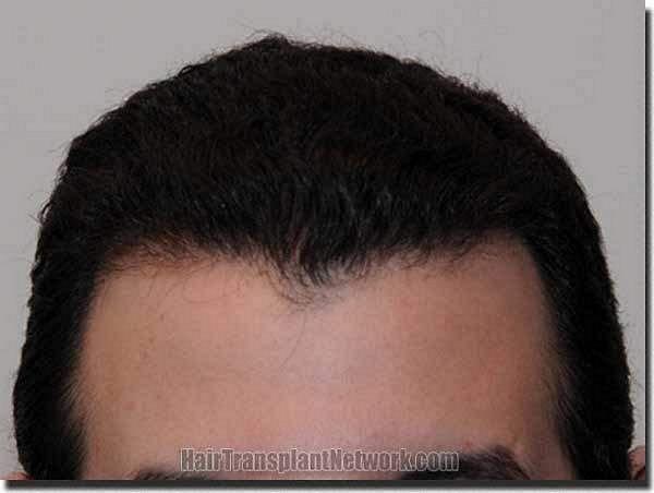 Hair restoration procedure results