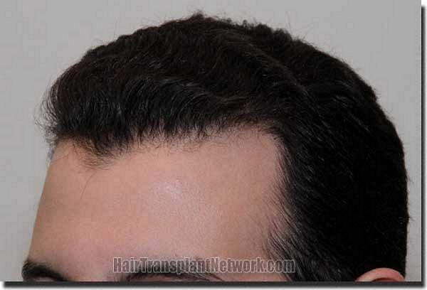 Hair restoration procedure results