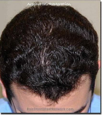 Hair restoration procedure results