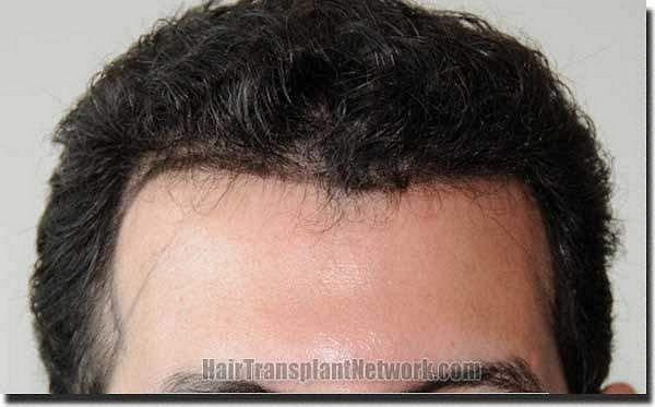 Hair restoration procedure results