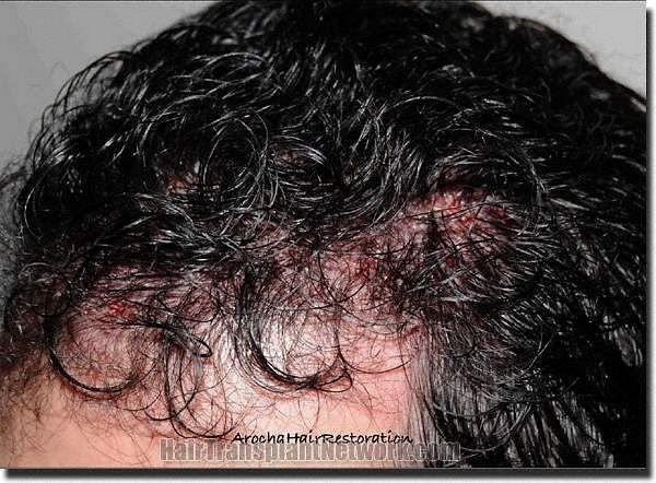 Hair restoration procedure results