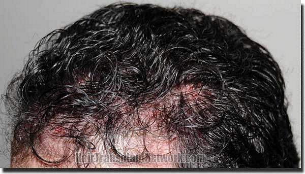 Hair restoration procedure results