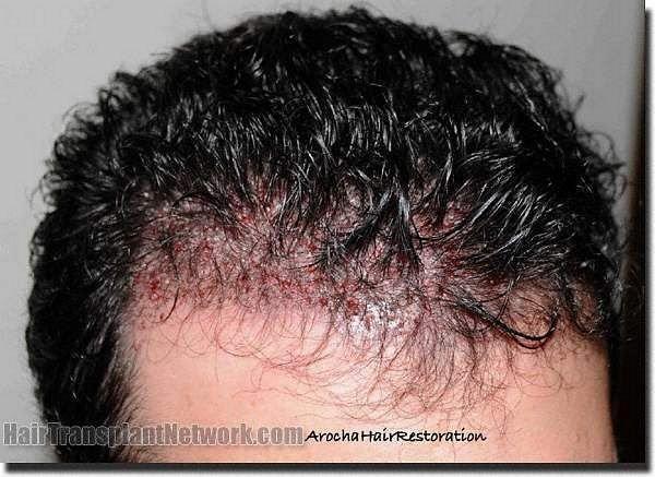 Hair restoration procedure results