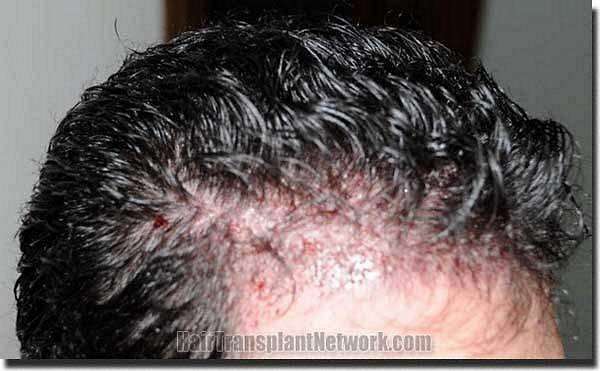 Hair restoration procedure results