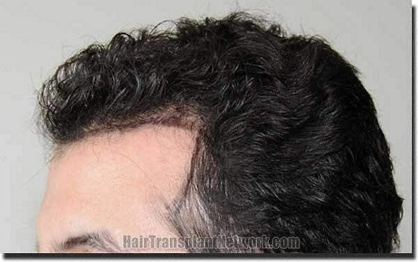 Hair restoration procedure results