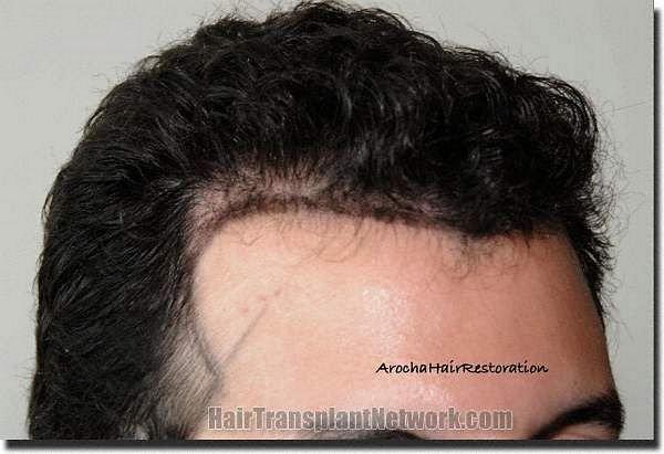 Hair restoration procedure results