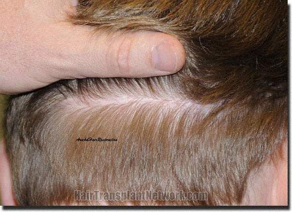 Hair restoration procedure results