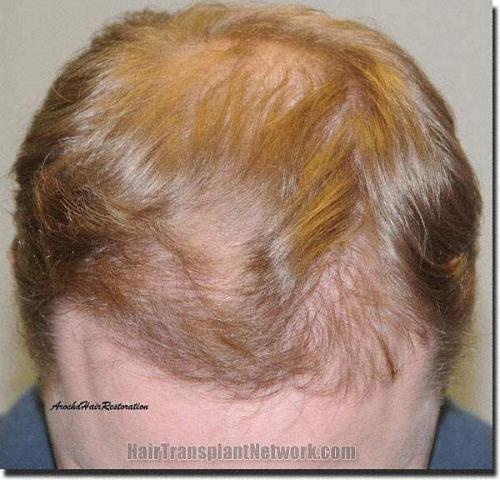 Hair restoration procedure results