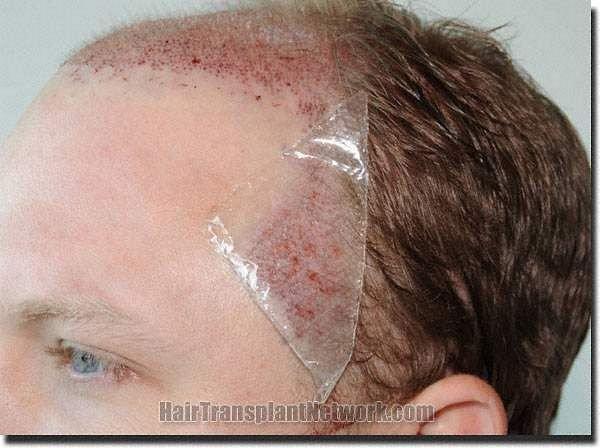 Hair restoration procedure results