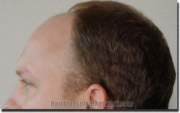 Hair restoration procedure results