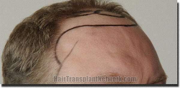 Hair restoration procedure results