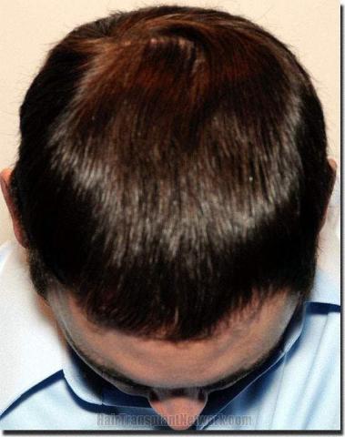 Hair restoration procedure results