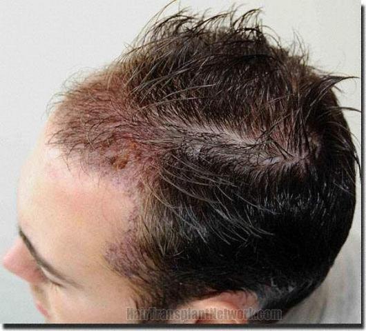 Hair restoration procedure results