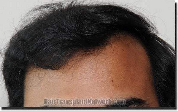 Hair restoration procedure results