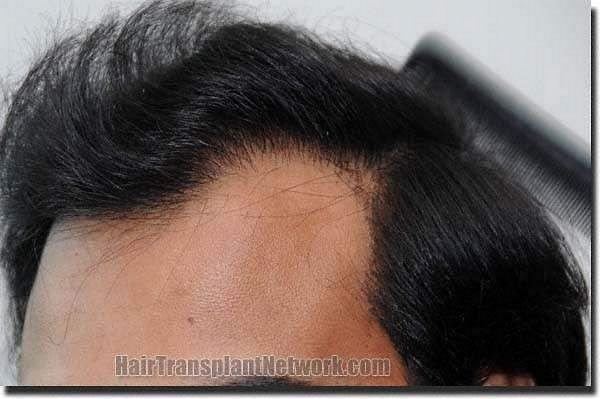 Hair restoration procedure results