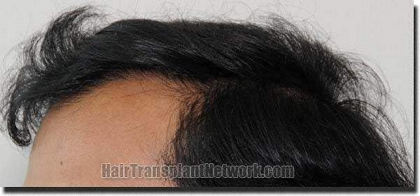 Hair restoration procedure results