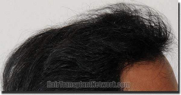 Hair restoration procedure results