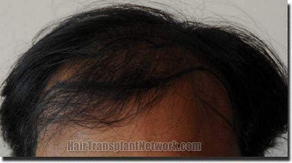 Hair restoration procedure results