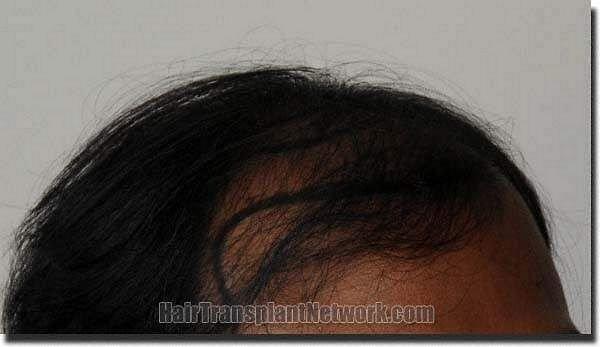 Hair restoration procedure results