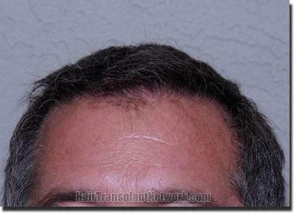 Hair restoration procedure results