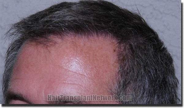 Hair restoration procedure results