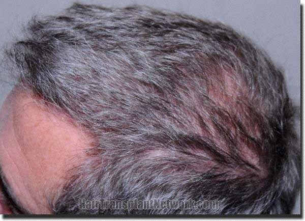 Hair restoration procedure results