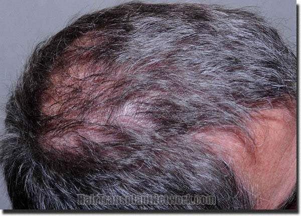 Hair restoration procedure results