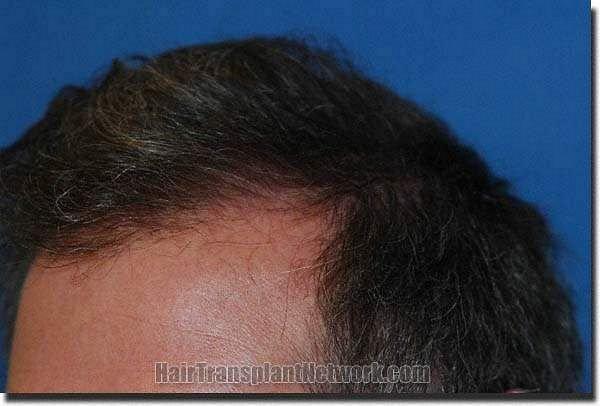 Hair restoration procedure results