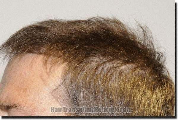 Hair restoration procedure results