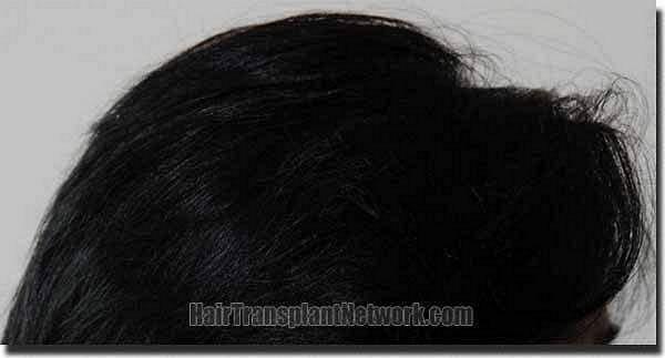 Hair restoration procedure results