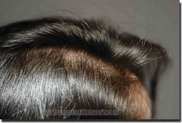 Hair restoration procedure results