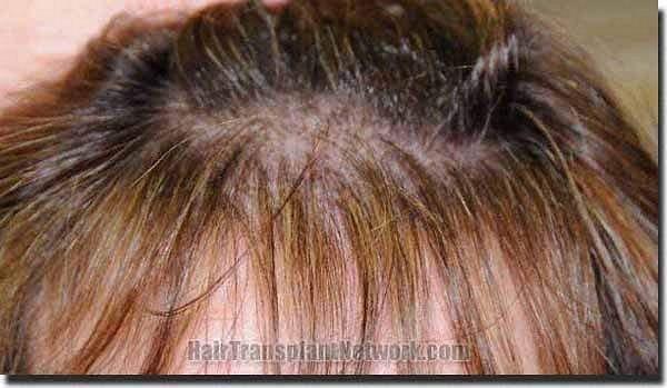 Hair restoration procedure results