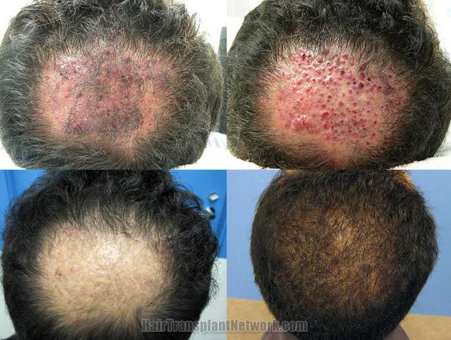 Before and after artificial hair removal and transplant