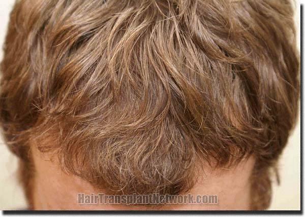 Hair restoration procedure results